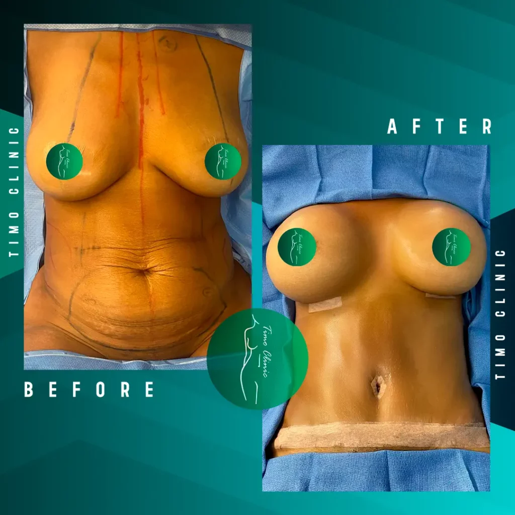 Before and After Timo Clinic Esthetic Surgery 4