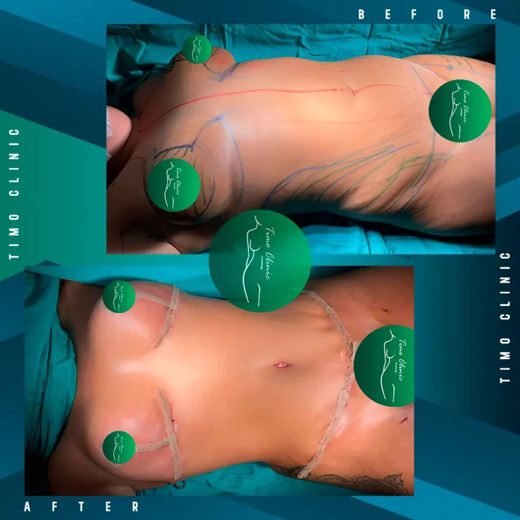 Before and After Timo Clinic Esthetic Surgery 5