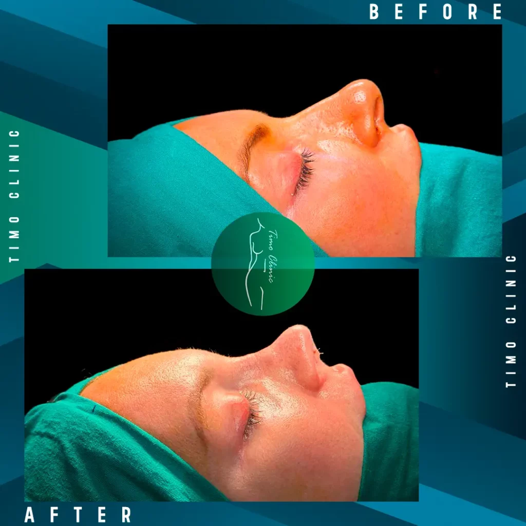 Design Before and After Timo Clinic Esthetic Surgery