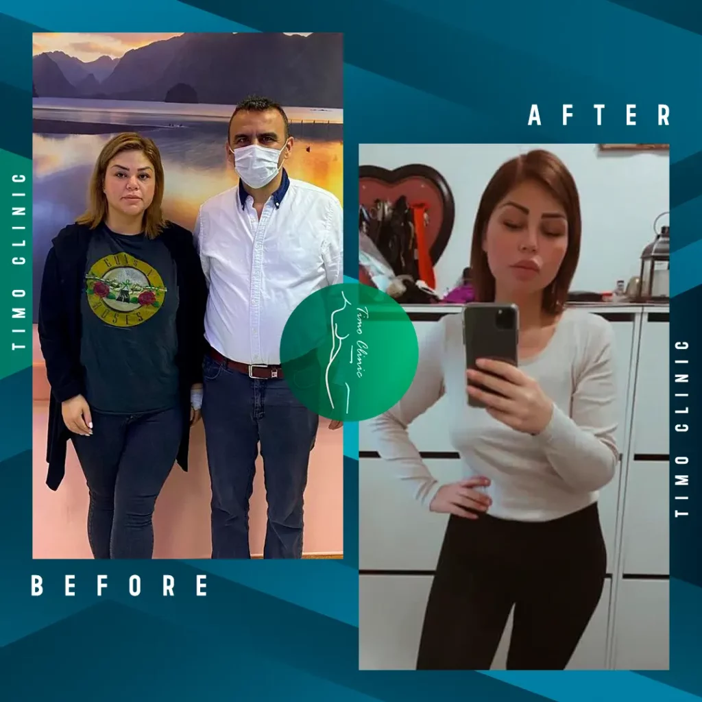 Design Before and After Timo Clinic Weight Loss 13