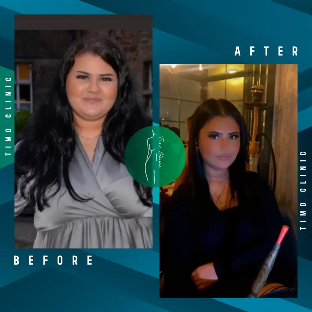 Design Before and After Timo Clinic Weight Loss 15