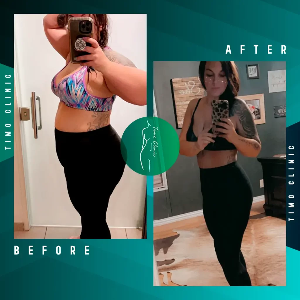 Design Before and After Timo Clinic Weight Loss 17