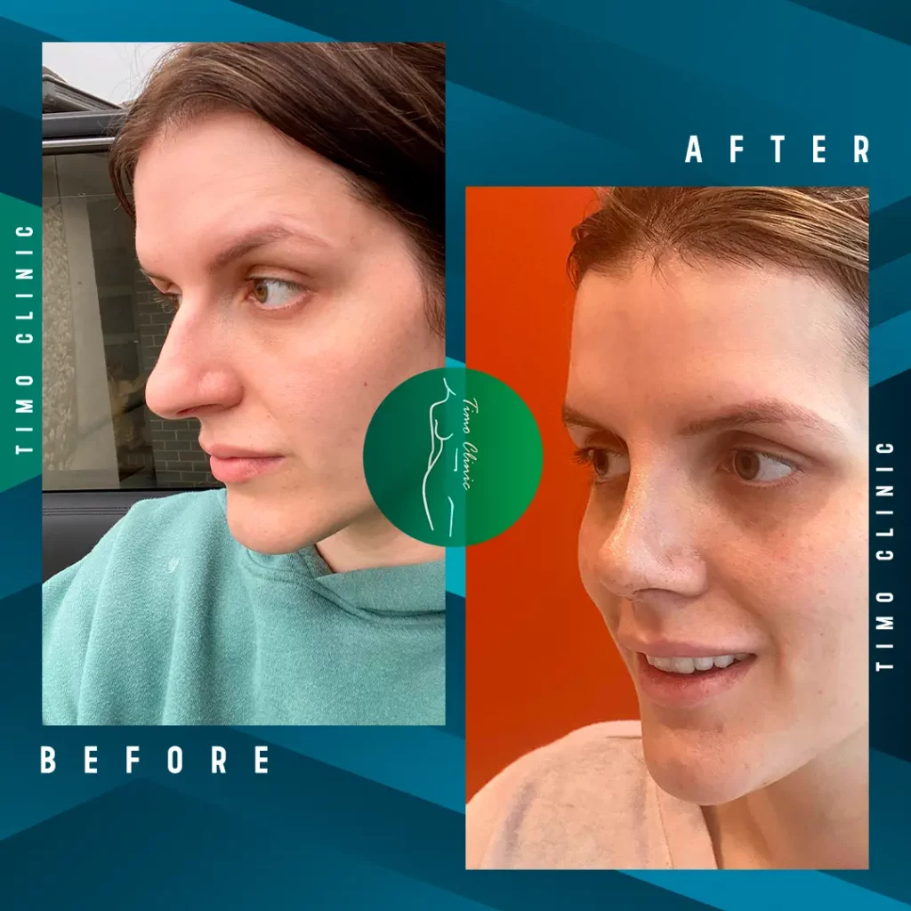 Design Before and After Timo Clinic design Blue rhinoplasty 1 week post op
